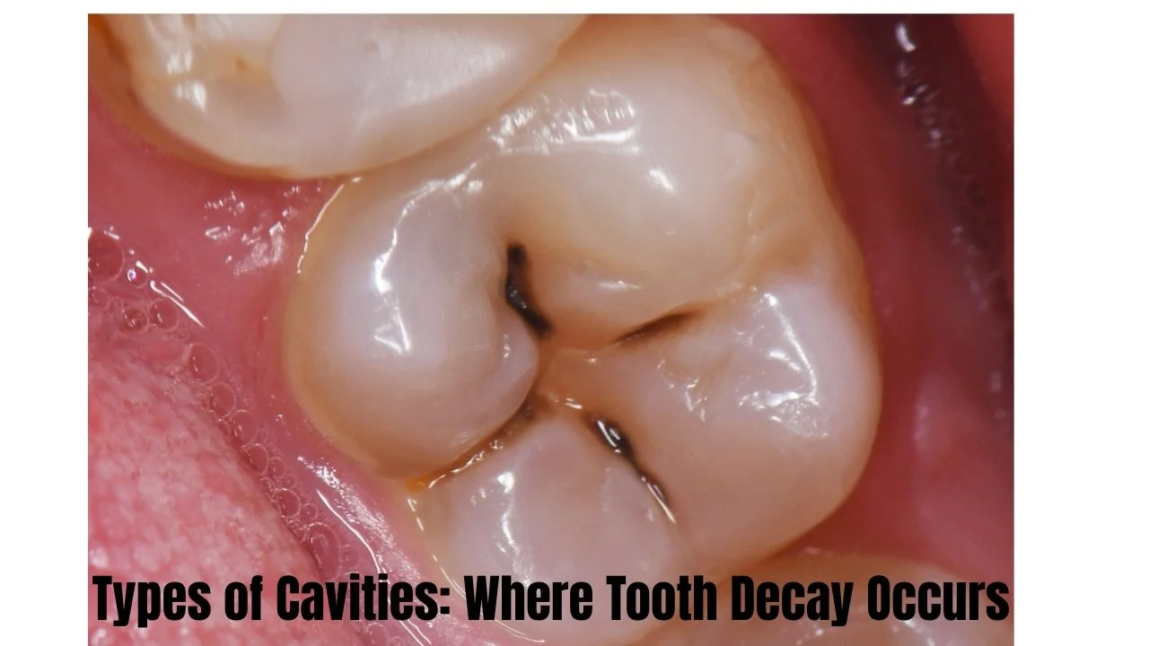 Types of Cavities: Where Tooth Decay Occurs