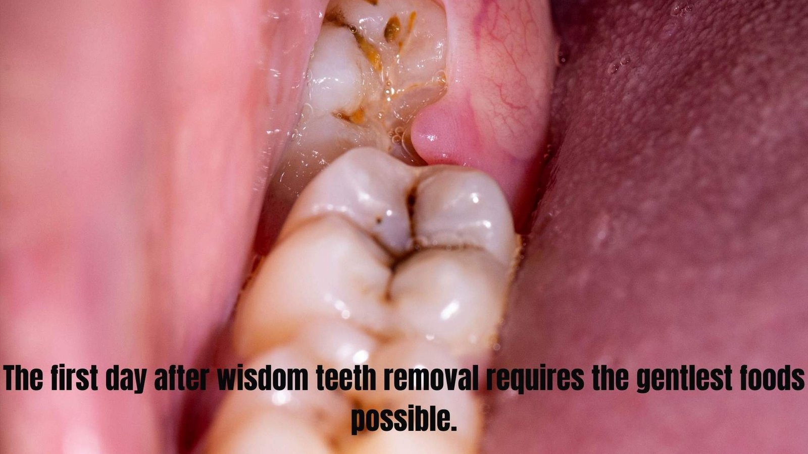 Best Foods To Eat After Wisdom Teeth Removal